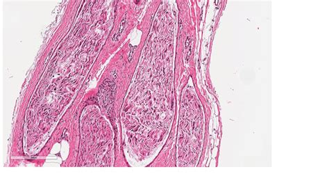 Sural nerve biopsy. 10×. H&E stain. Nerve biopsy revealing multiple ...