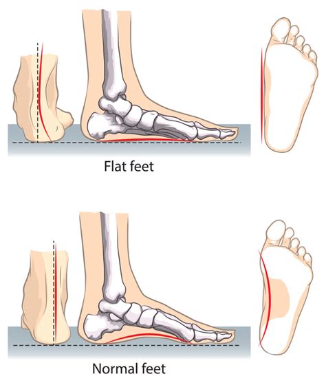 Flat Feet: Symptoms, Treatments & More | Red Mountain Footcare