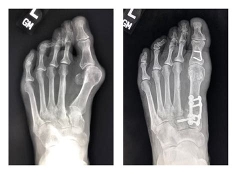 Black Hills Doctor Redefining Bunion Treatment — Midwest Medical Edition