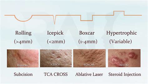 Scar Revision - DR SIN YONG