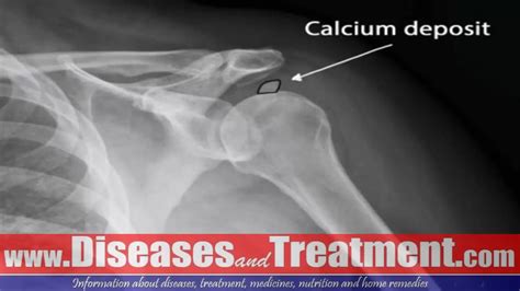 Calcific Bursitis : Causes, Symptoms, Diagnosis, Treatment - YouTube