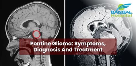 Pontine Glioma: Symptoms, Diagnosis And Treatment | Bansal Hospital