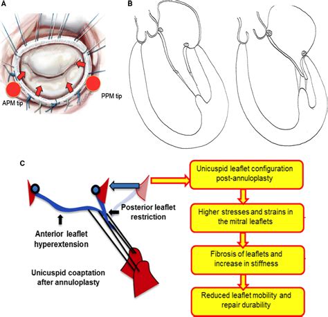 Pathological Remodeling Of Mitral Valve Leaflets From Unphysiologic ...