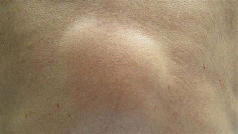 Lipoma (Skin Lumps): Causes, Diagnosis, and Treatments