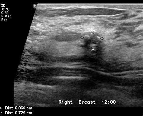 Fibroadenoma echocardiography or ultrasound - wikidoc