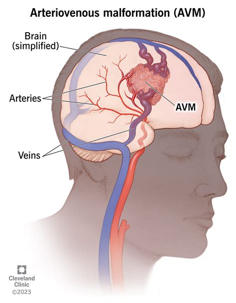 Arteriovenous Malformation (AVM): Causes & Symptoms