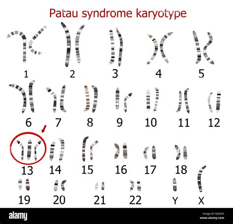 Patau syndrome karyotype (trisomy 13 Stock Photo - Alamy