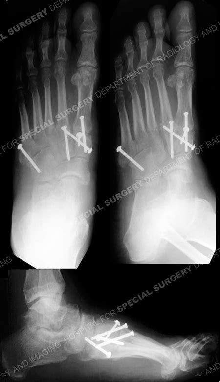 Lisfranc Fracture Dislocations - Orthopedic Trauma Service