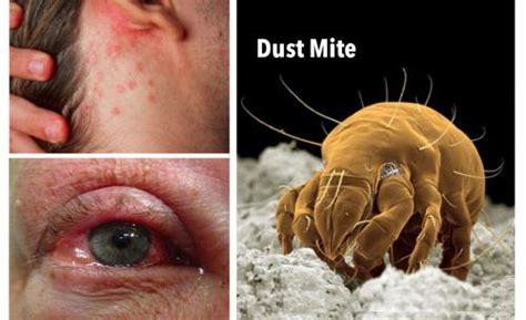 Dust Mite Infections are Found in 4 Out of 5 Homes. Kill Them With This ...