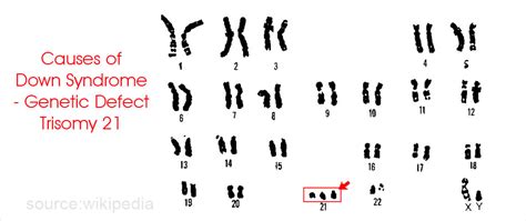 Down Syndrome - Trisomy 21, Causes, Symptoms, Diagnosis, Treatment, Prognosis