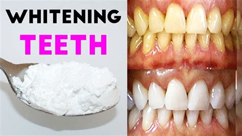 Teeth Whitening With Baking Soda - How To Whiten Teeth - YouTube