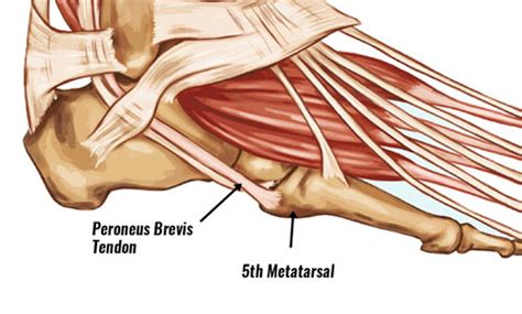 Peroneus Brevis Tendon Strain - Symptoms, Causes, Treatment, Exercises