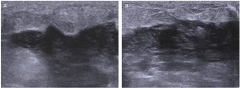 Mastitis On Ultrasound