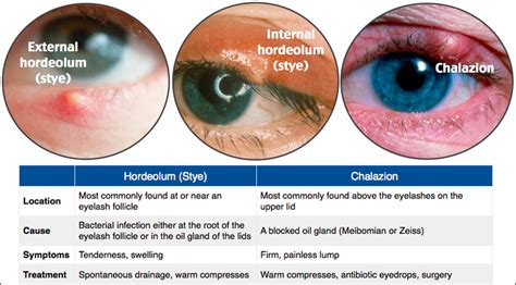 Hordeolum vs Chalazion Hordeolum (Stye): • Location: ... | GrepMed