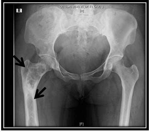 McCune Albright syndrome: an endocrine medley | BMJ Case Reports