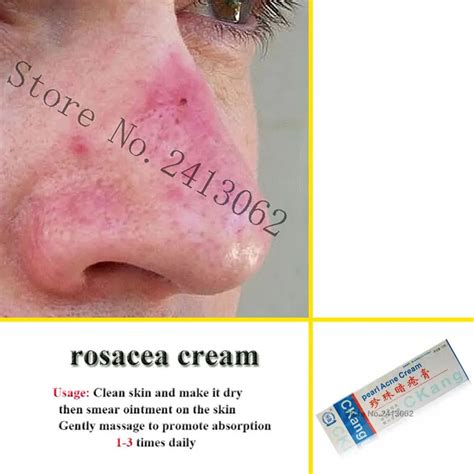 Rosacea cream Red nose ointment remove blackhead acne cream Skin care ...