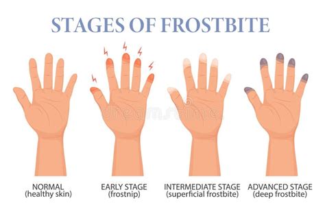 Frostbite Stages. Frozen Hands in Different Stages. Medical Frostbite ...