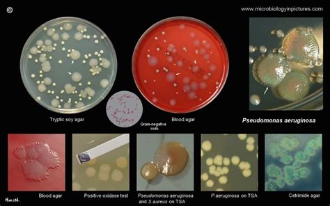 Pseudomonas aeruginosa: Infections, Pathogenesis and Lab Diagnosis
