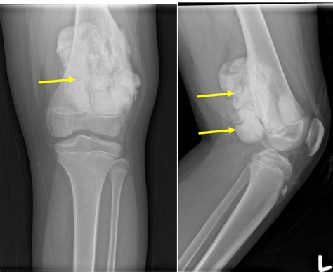 Parosteal osteosarcoma – Radiology Cases