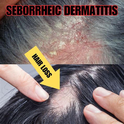 News: Can Seborrheic Dermatitis Cause Hair Loss?