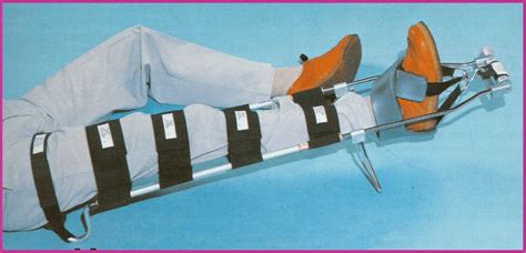 Femur Fracture in the ED - Remove the Traction - County EM