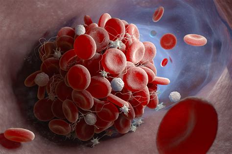 Signs & Symptoms of a Blood Clot: American Blood Clot Assoc.