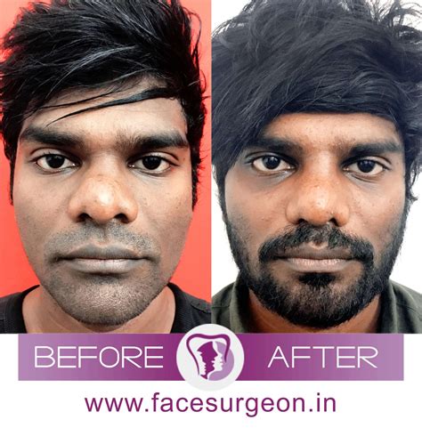 How To Reduce Size Of Nose - Flatdisk24