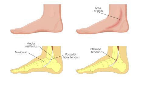 Relieving Posterior Tibial Tendonitis - Sport Doctor London