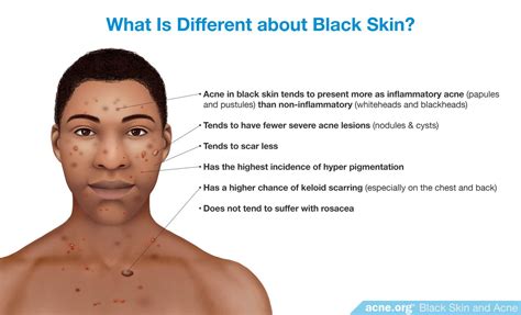 Treating Acne in Black Skin - Acne.org