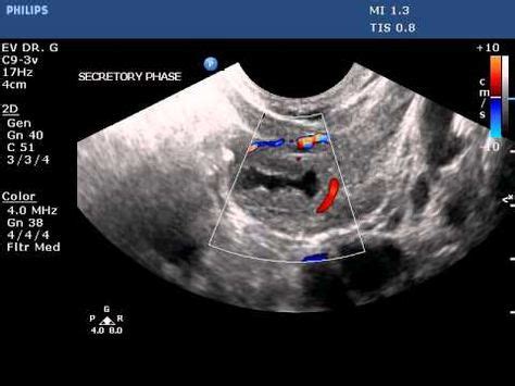 Complex corpus luteum cyst | Ultrasound sonography, Corpus luteum ...