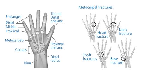 Metacarpal Neck Fracture