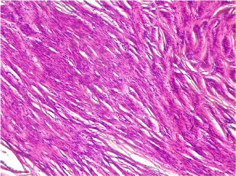 Appearance of low magnification ovarian fibroma. | Download Scientific ...