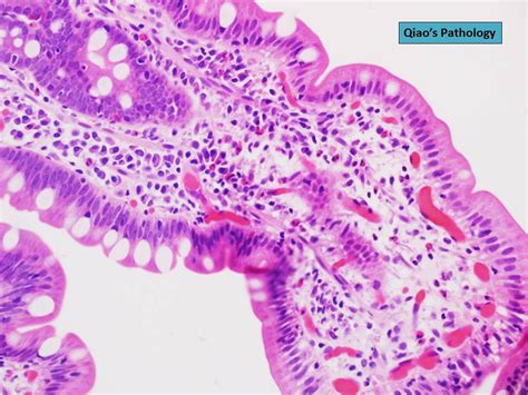 Qiao's Pathology: Eosinophilic Duodenitis | Microscopic phot… | Flickr