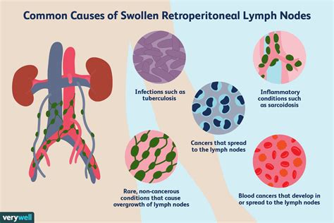 Lymph Node Size Chart - Best Picture Of Chart Anyimage.Org