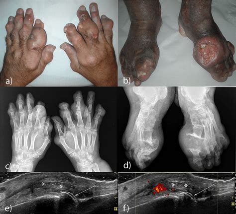 a, b Multiple gigantic tophi at the hands/feet level. c, d X-ray of the ...