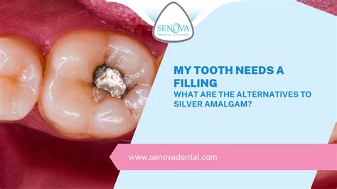 My Tooth Needs A Filling – What Are The Alternatives To Silver Amalgam ...