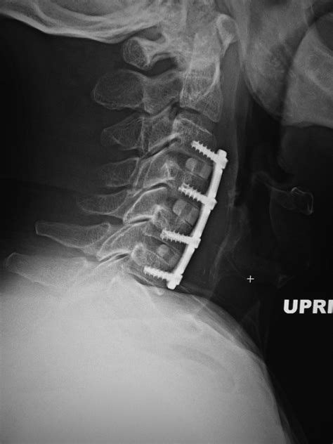 cervical spine fusion surgery - Yahoo Image Search Results | Cervical ...