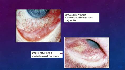 Ocular cicatricial pemphigoid, Stevens-Johnson Syndrome, Toxic Epider…