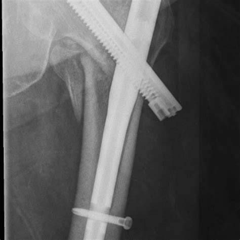 Conversion total hip arthroplasty following extracapsular hip fracture fixation with a ...