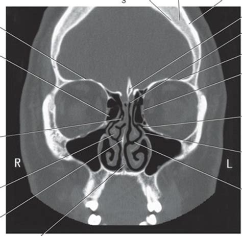 Sectional: Coronal CT of Ethmoid Bone Diagram | Quizlet