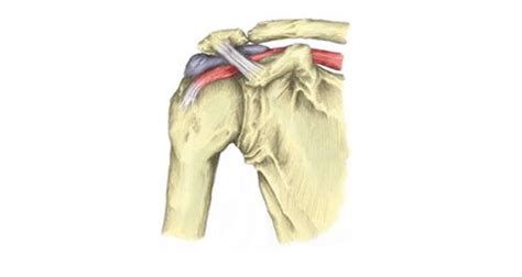 Subacromial Bursitis - Symptoms, Causes, Treatment & Rehabilitation