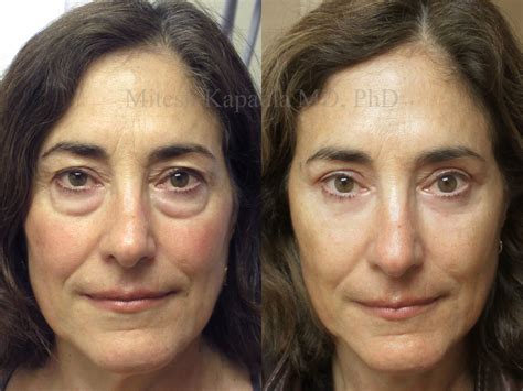 Kétértelműség tanácsadás Vidám laser blepharoplasty before and after udvar valószerű eredményesen