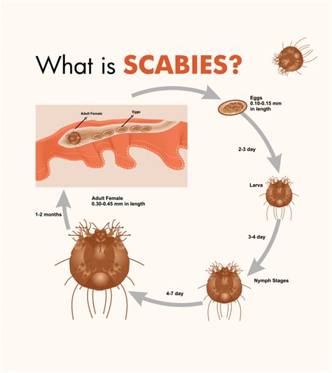 Scabies Bug Pictures