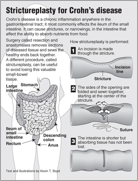 Crohn’s Strictureplasty – PointFinder Health Infographics