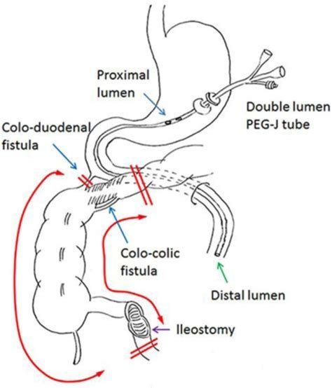 Schema showing the gastro-jejunostomy tube, the locatio | Open-i