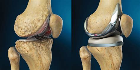 #Total Knee Replacement Treatment in Thane | Dr Kuldeep Gadkari