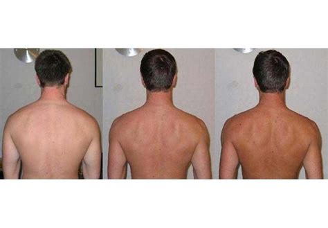 Before and after Melanotan tanning therapy, sunless tanning results ...