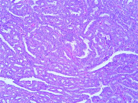 Tubular adenoma – Histopathology.guru