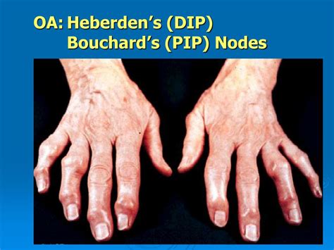 Heberden And Bouchard Nodes