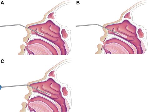 Pediatric turbinate reduction by coblation - Operative Techniques in Otolaryngology-Head and ...